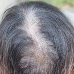 A senior woman whose hair is thinning.